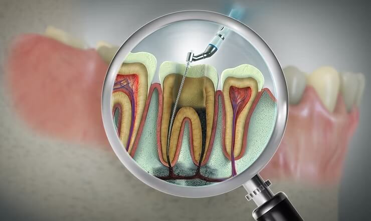 Debunking Root Canal Myths: Why You Might Need One and How Rovi Smile Center Can Help