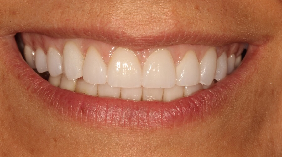 Full Mouth Restoration After