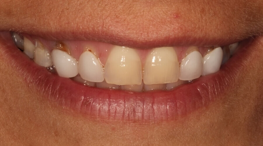 Full Mouth Restoration Before