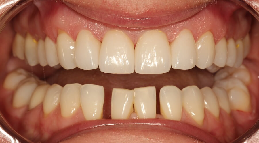 Smile Makeover After