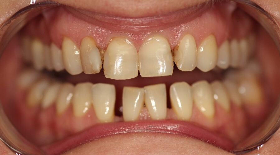Smile Makeover Before