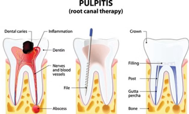 Pulpitis