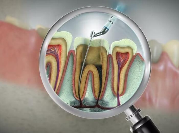 Debunking Root Canal Myths: Why You Might Need One and How Rovi Smile Center Can Help