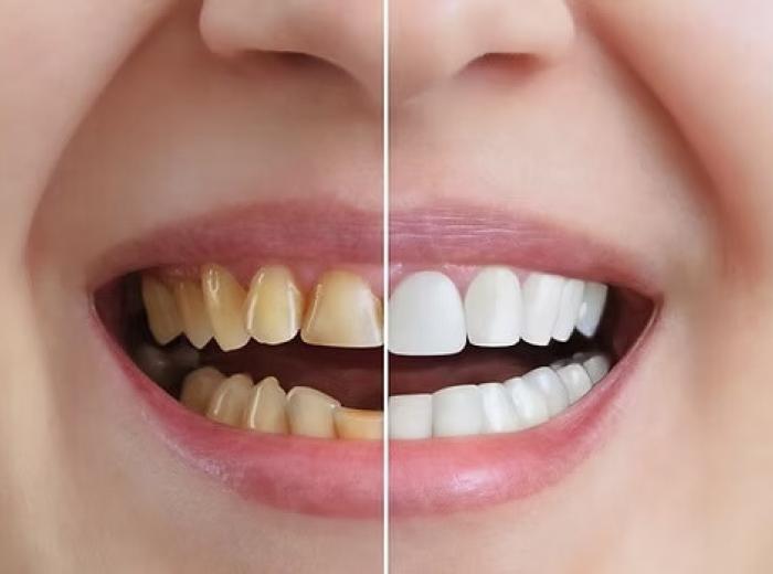 Cosmetic Dentistry: Innovations and Options for 2026 at Rovi Smile Center in Coral Springs, Florida