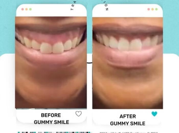 Non-Invasive Treatments for Gummy Smile: Botox and Laser Options for a Confident Holiday Smile